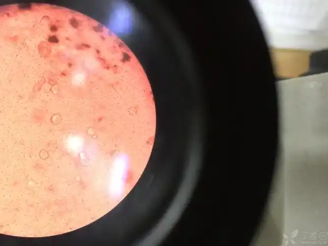 白带常规中高倍镜发现一组蜂窝状改变细胞