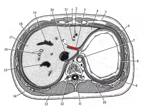 图(6):图中红色区域标示为肝脏静脉韧带裂
