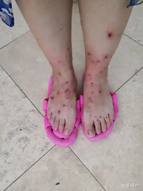 被跳蚤咬的全身都是包是什么样的感受