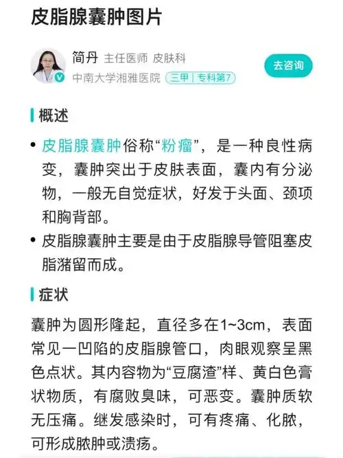皮脂腺囊肿怎么办-多年就医经验分享
