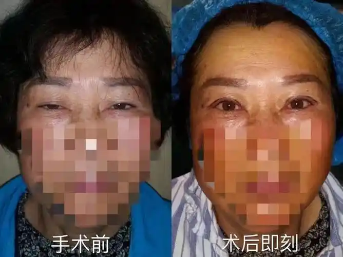 成人知觉性斜视术前,术后对比