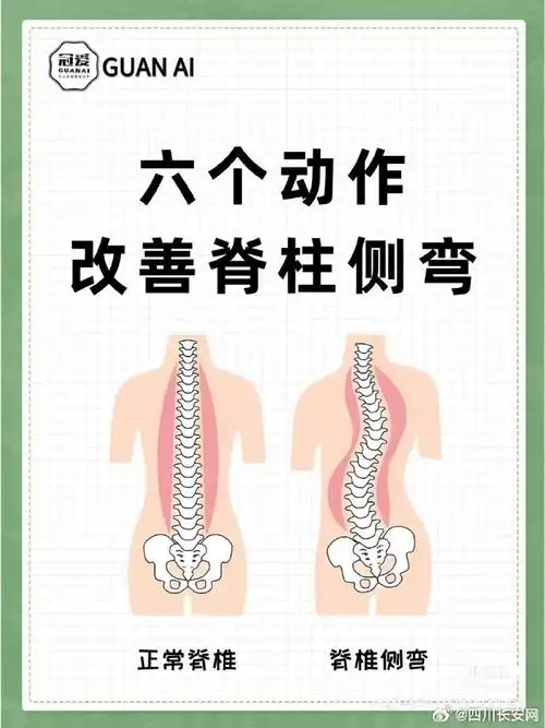 1个校区就发现76例学生脊柱侧弯