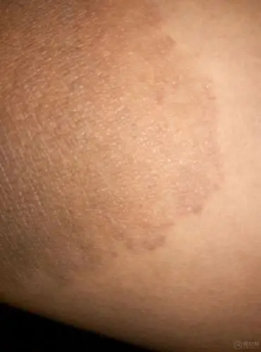 阴囊湿疹痒痒痒