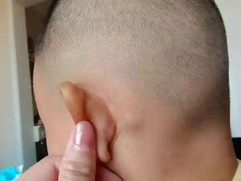 三岁孩子耳朵后面长了一个疙瘩