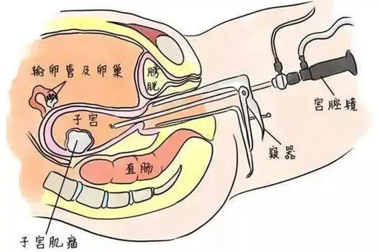 腹腔镜下亚甲蓝通液对同时合并生殖系统疾病需行腹腔镜手术处理者可