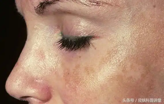 脸上的黄褐斑是什么原因引起的怎么去除黄褐斑