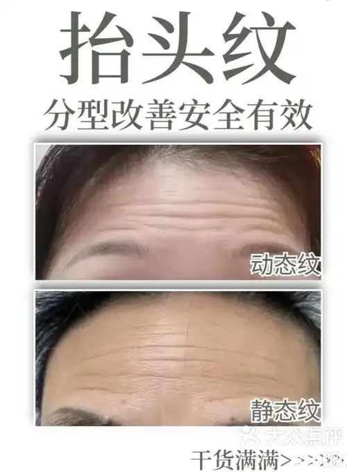 你的抬头纹是静态纹还是动态纹