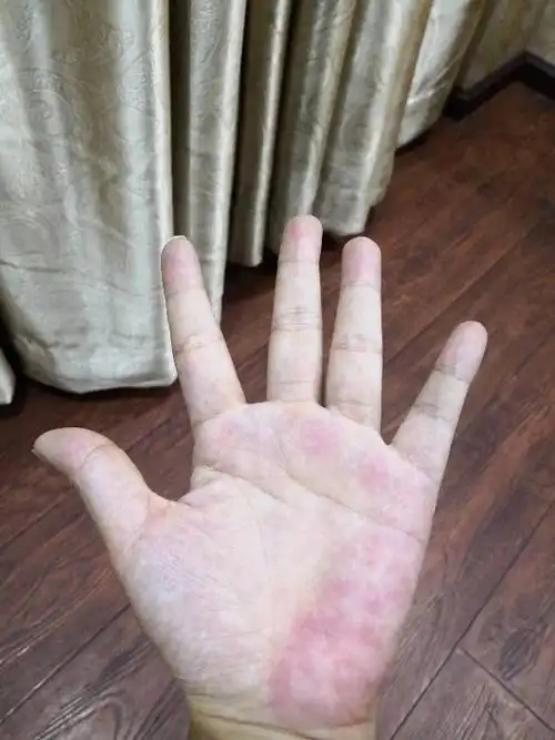 手掌长年发红发花是什么原因?而且感觉越热的时候越红,怎样解决?