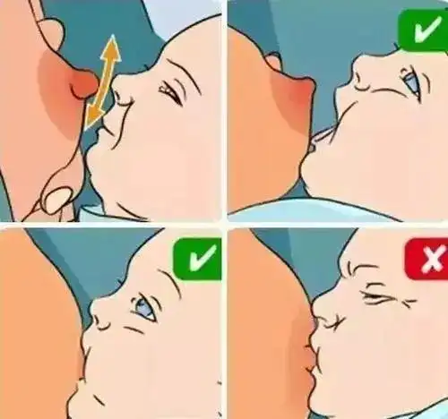 开乳过迟,或哺乳不定时,或哺乳时乳汁不能排空,宝宝含乳姿势不正确