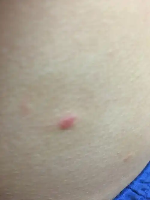 腰上突然出现了红疙瘩不疼不痒是怎么回事