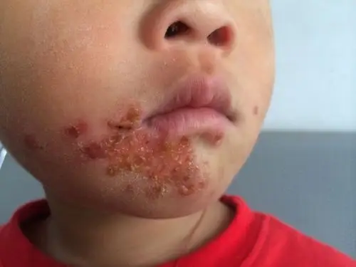 又见脓疱疮