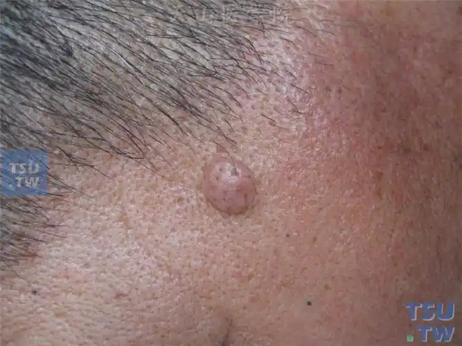 皮内痣:面部约绿豆大小半球形淡褐色结节