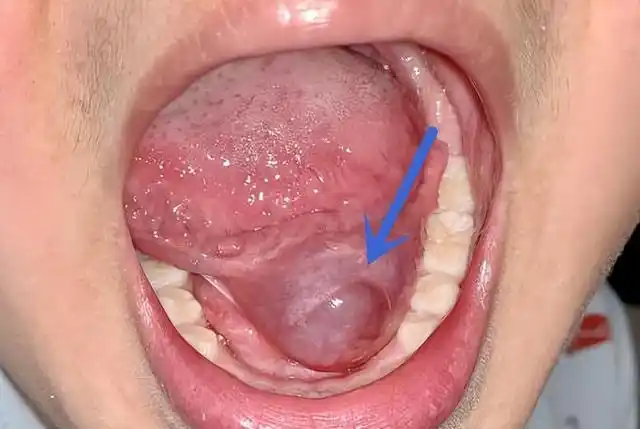 舌下腺囊肿变成血泡(舌下长水泡)(3)