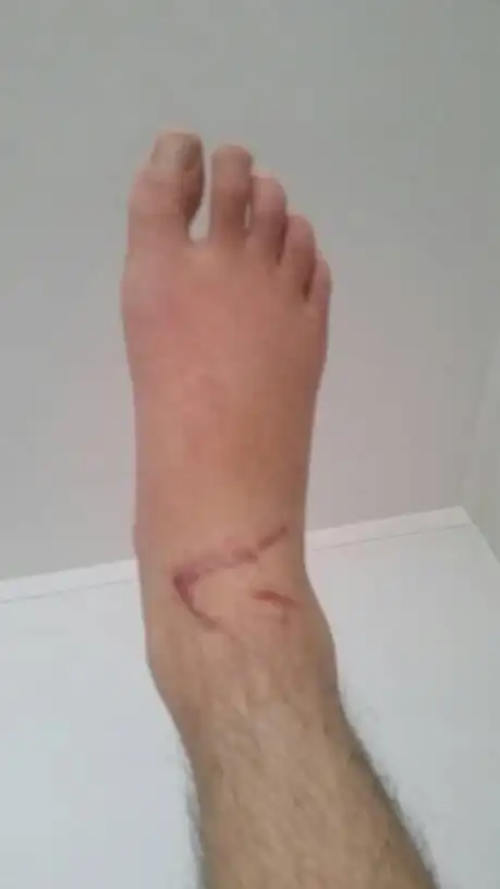 我的五根脚筋断裂,现在已有两个月,请问有什么锻炼方法, 我拄拐下地