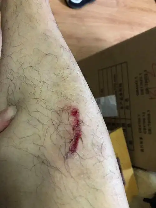 男生腿受伤的图片带血,腿摔流血的照片-图片大观-奇异网