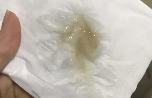 早起上厕所1个情况,宫颈癌来献"殷勤","赶跑"hpv防癌变__凤凰网