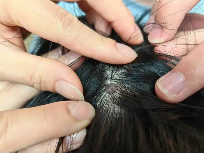 其实两个还都是软纤维瘤,一种比较常见的良性皮肤肿瘤.