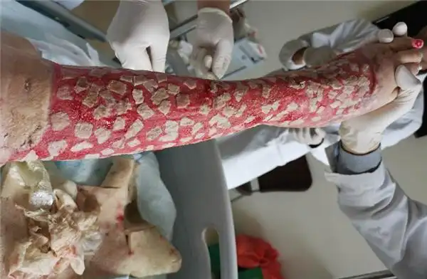 张璇接受了第二次植皮,将剩余皮肤缺损地方补齐,2次手术共移植超百块