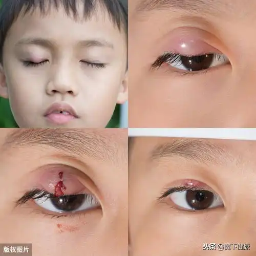 患儿免疫力低下,睑腺炎症反应剧烈,容易发展为眼睑蜂窝织炎