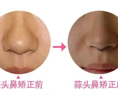 很多人不知道蒜头鼻是啥,这样图解可以吗?
