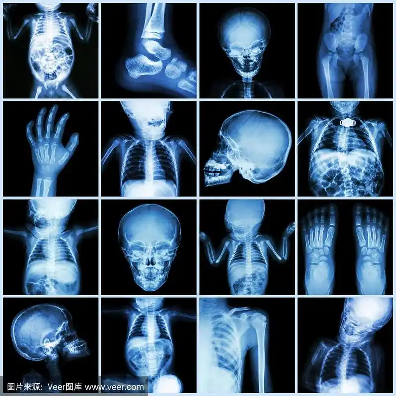 收集儿童身体部分的x光片