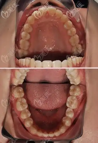 合肥美奥口腔医院潘光东术后照片1