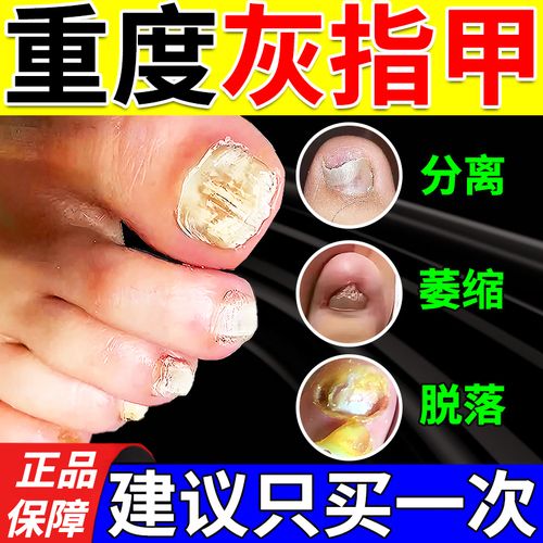灰指甲专用药灰指甲根裉治正品甲沟炎灰指甲药膏指甲真菌感染脱甲坏甲