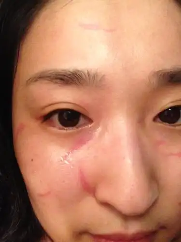 受伤十天,结痂脱落就,这种红色微微凹陷的