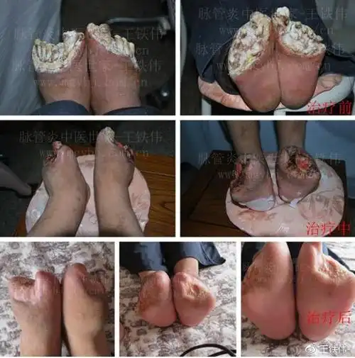 烂手烂脚怎么办?治疗脉管炎方式多样?哪种方法治疗效果好?