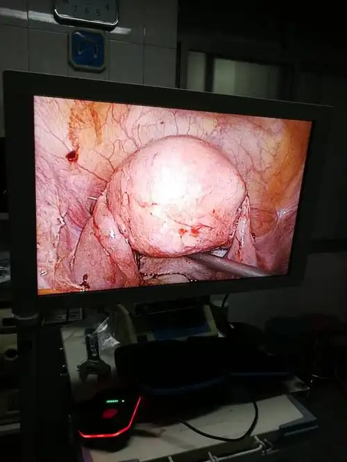 腹腔镜下输卵管吻合的体会