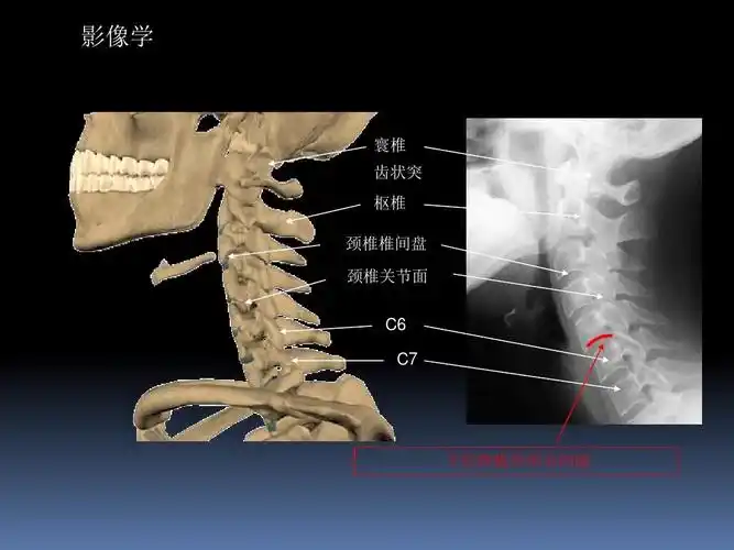 医药卫生 临床医学 颈椎病和腰椎间盘突出症的诊治ppt 影像学 寰椎