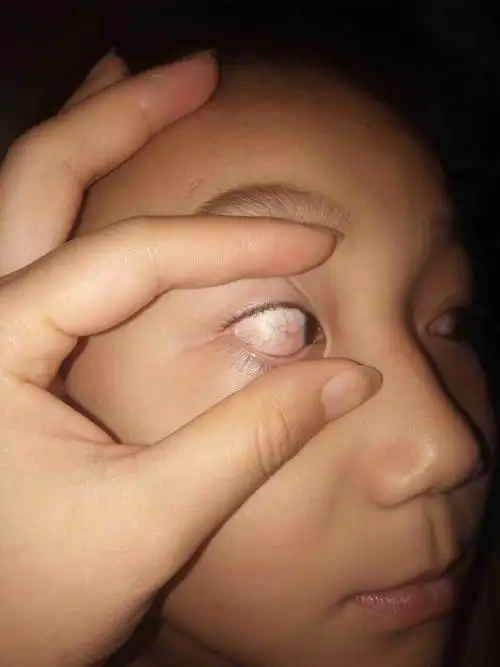 儿童眼睛红血丝多怎么治疗