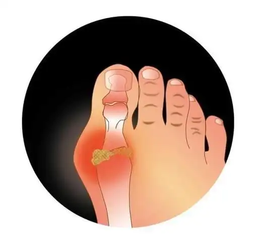 痛风患者会出现大脚趾疼痛,红肿和灼热感