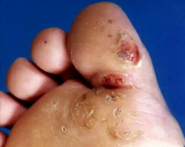 六盘水疣专家_六盘水治疗疣哪个专家好_六盘水治疗疣最好的专家/排行