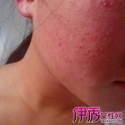 女人梅毒图片大全展示 揭秘其详细防治措施