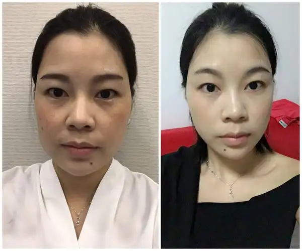 里——到达筋膜层并向上提拉,就好像韧带一样,让下垂的软组织回归原位