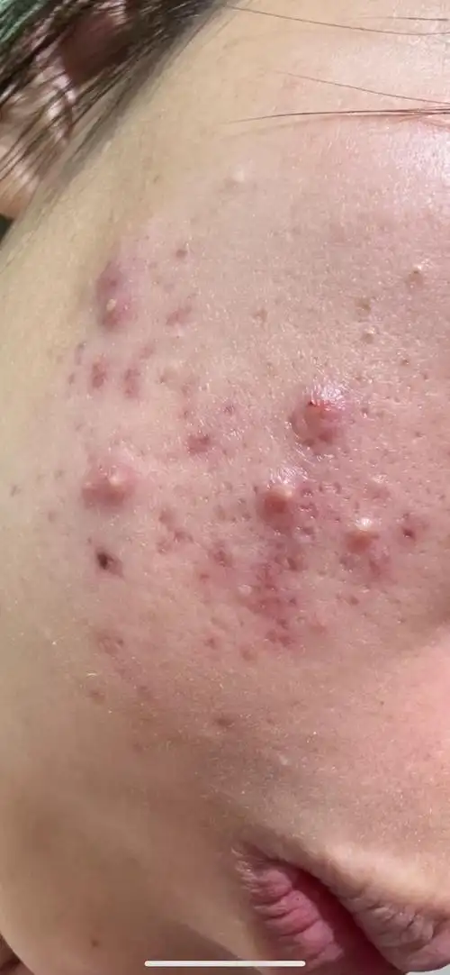 再好看的一张脸 
如果满脸痘痘