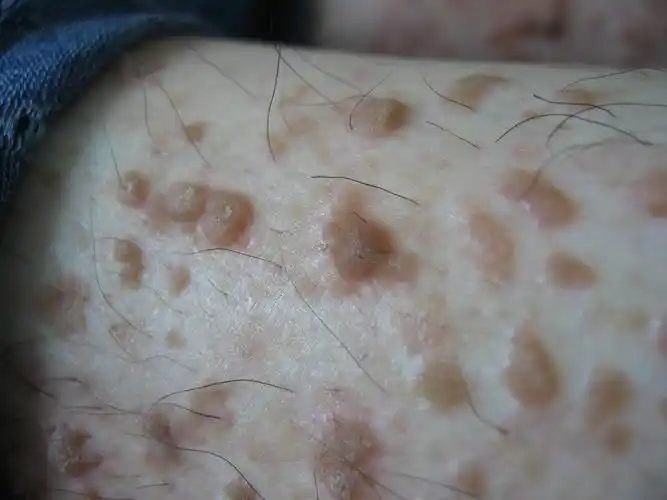 看图识病疣状皮肤角化不全