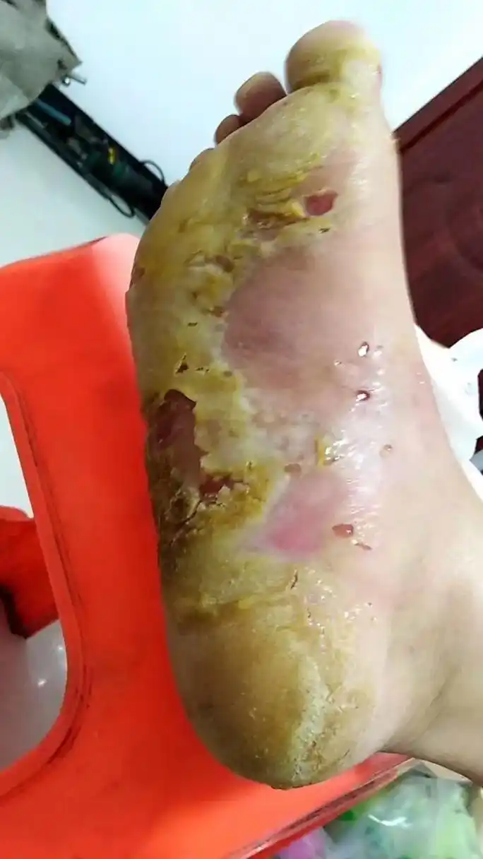 这就是特別严重的细菌性感染,八年的皮肤病患者 - 抖音