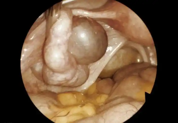 输卵管积水怎么办