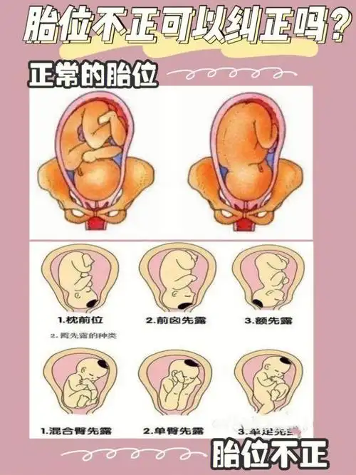 了解胎位不正及时调整和避免
