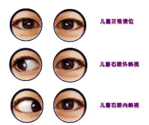也可能是斜视 我按照图分析了一下,基本确定是第三种