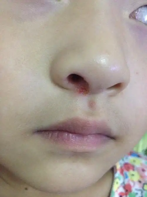 涂了红霉素也没见好,还能涂什么药膏啊?