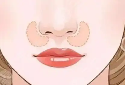 玻尿酸丰鼻唇沟更深了是真的吗真实案例果告诉你答案