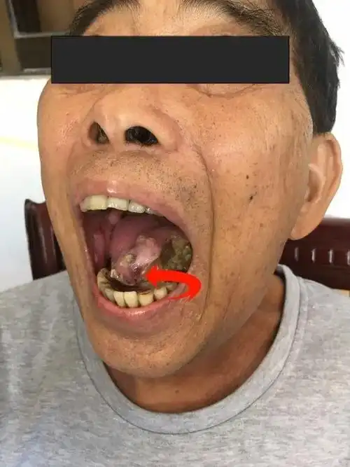 老伯整个舌头长满了肿瘤没想到竟是口腔溃疡引起