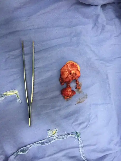 4岁女童腹膜后神经母细胞瘤