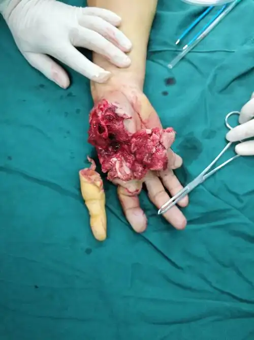 南康区第一人民医院骨科团队又完成一例高难度手外科保肢手术