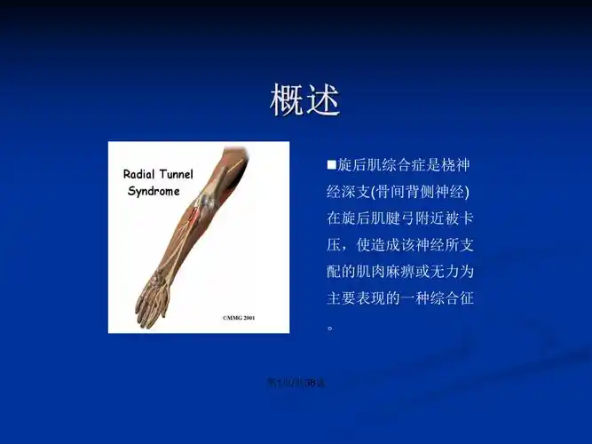 旋前圆肌综合症精ppt学习教案