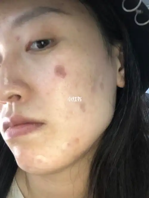 液氮冷冻扁平疣第二天