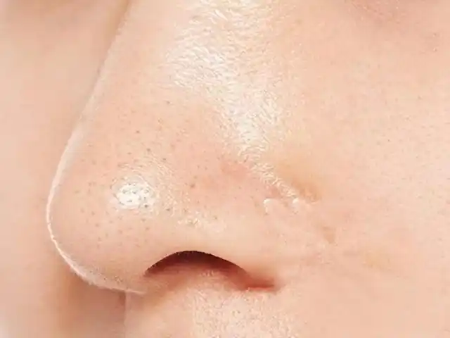 脸上的黑头粉刺很苦恼,市面上去黑头的方法层出不穷,如何选择?